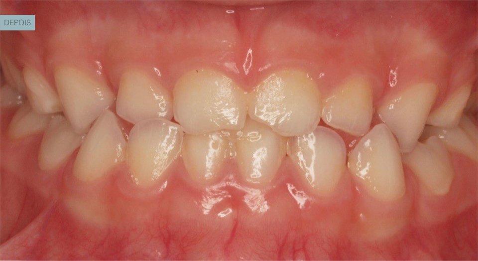 Ortodontia - Caso clínico 6 #2