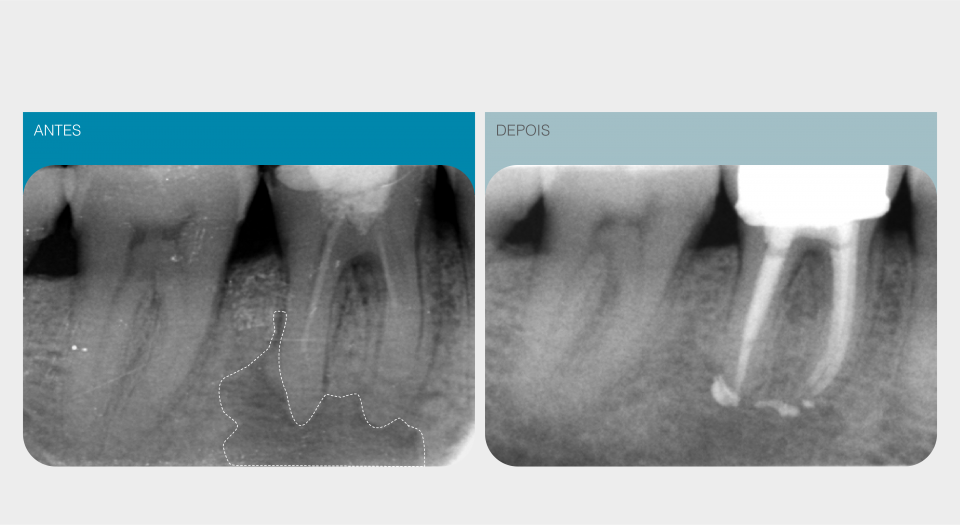 Endodontia - Caso clínico 2 #1