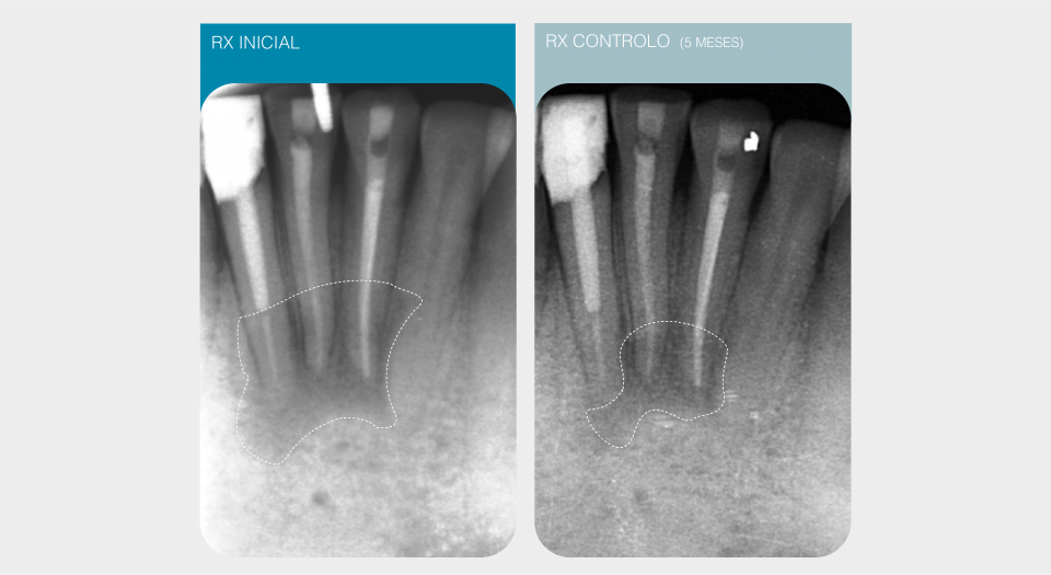 Endodontia - Caso clínico 3 #1