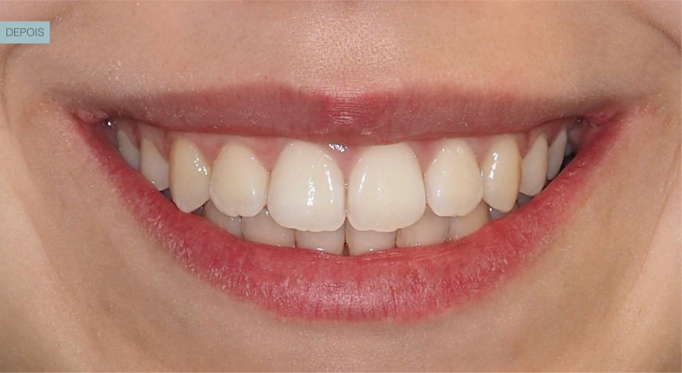 Ortodontia - Caso clínico 1 #3